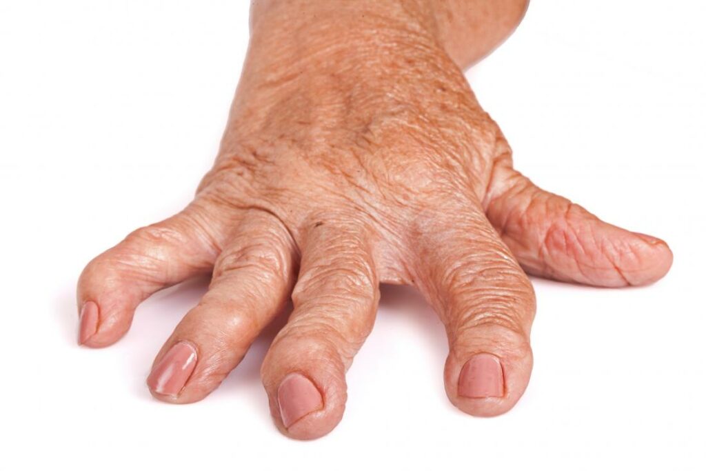 Ortoza za artritis prsta