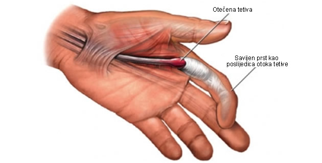 Ortoza za tendinitis prsta