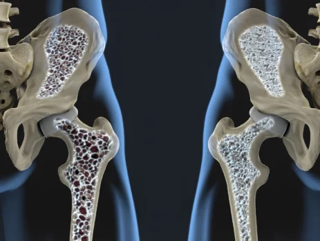Šta je osteoporoza