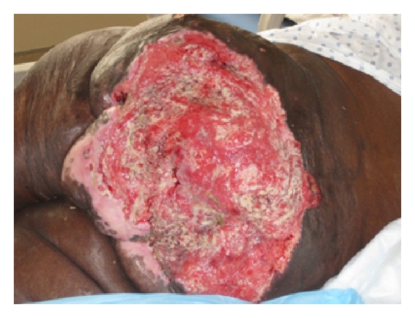 Dekubitus karcinom