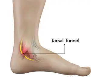 Tarsalni tunelski sindrom skocnog zgloba