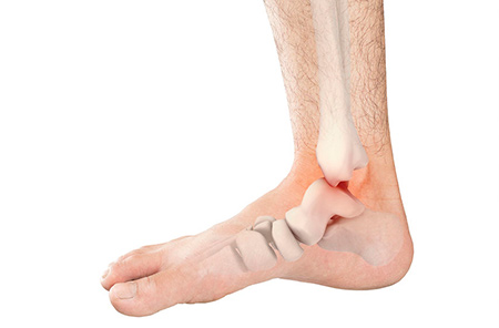 artroza skocnog zgloba (Osteoartritis)
