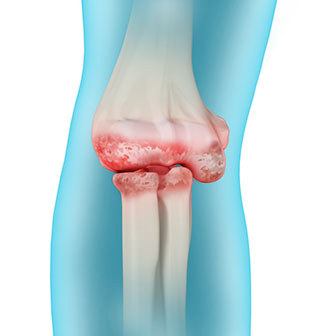 artritis lakta